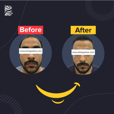 Slider image (5) Dr. Bagadia’s Hair Clinic & Transplant Centre